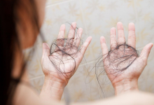 Saç Dökülmesi Nedenleri, Tedavileri ve Önleme Yolları